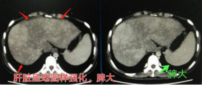 ​肝癌腹水偏方 肝腹水，原因是服用这个偏方调理身体